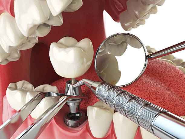 Best Broken or Chipped Tooth Repair in Beaver Dam, KY